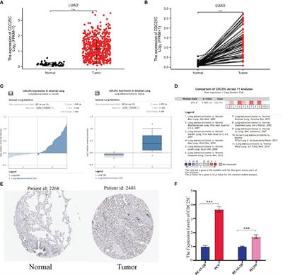 CDC25C as a Predictive Biomarker for Immune Checkpoint Inhibitors in Patients With Lung Adenocarcinoma